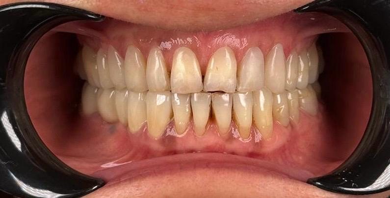 After — Composite veneers — no tooth cutting