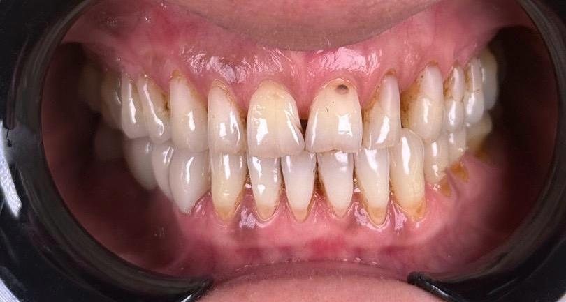 Before — Composite veneers — no tooth cutting