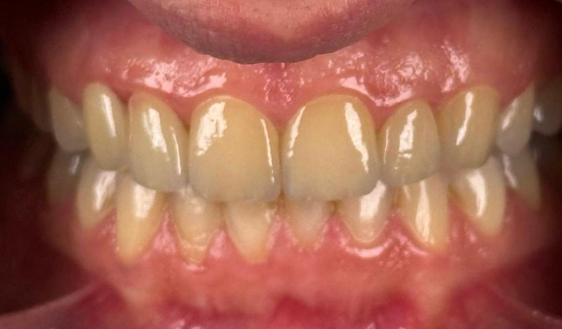 After — Composite veneers — no tooth cutting