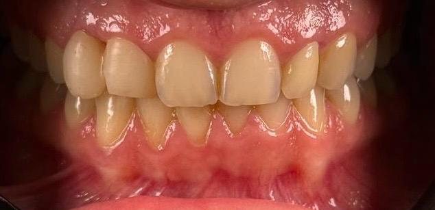 Before — Composite veneers — no tooth cutting