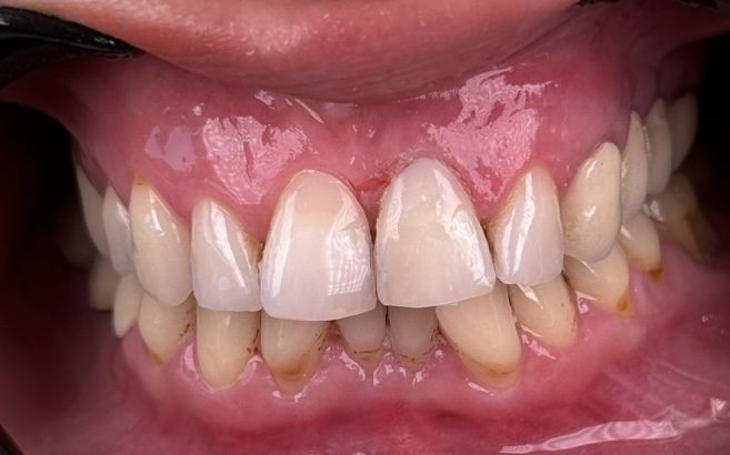 After — Hazan — after a dental trauma