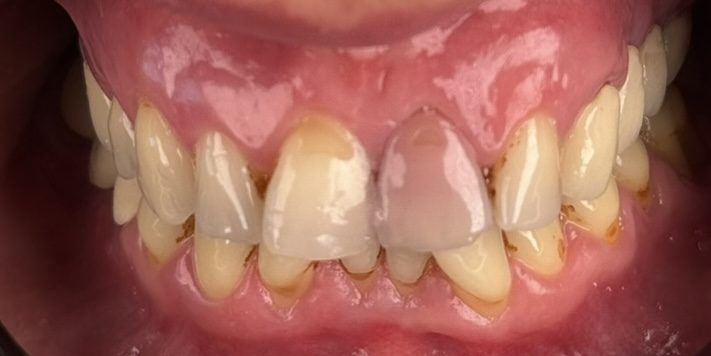 Before — Hazan — after a dental trauma