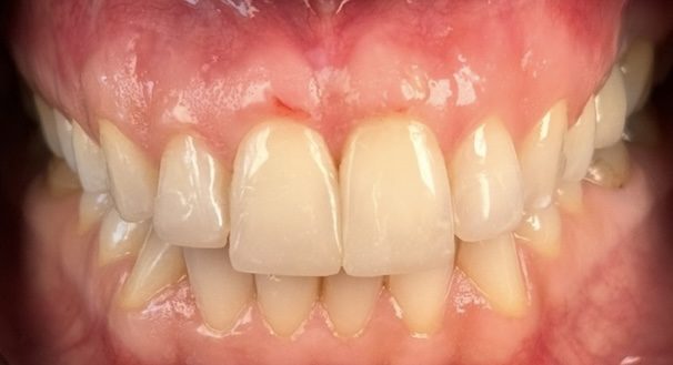 After — Sanem — composite, no cutting