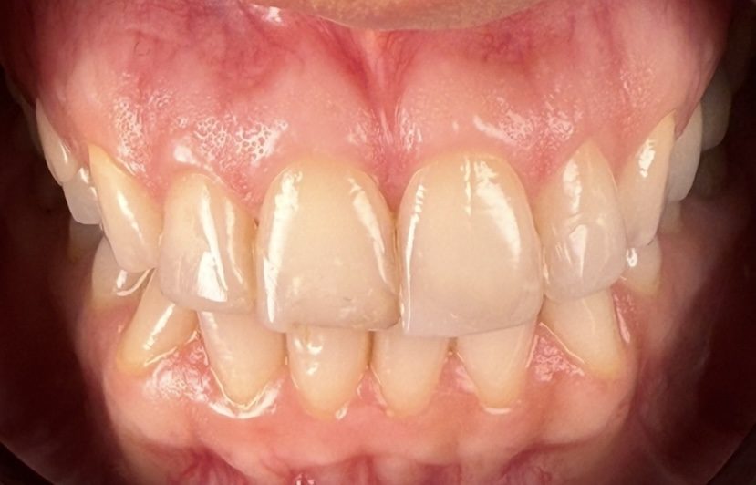 Before — Sanem — composite, no cutting