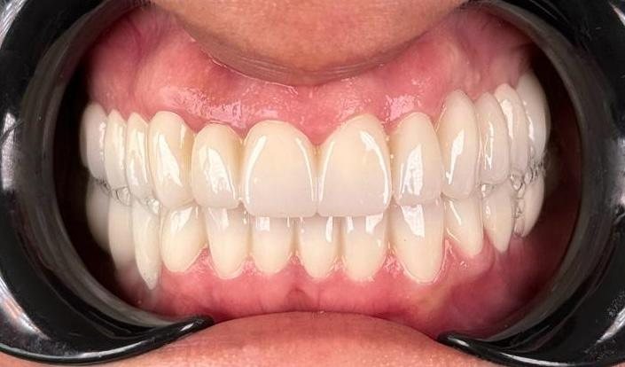 After — Natural monolithic zirconia