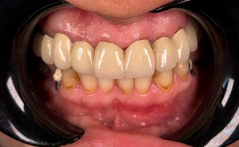 Before — Natural monolithic zirconia