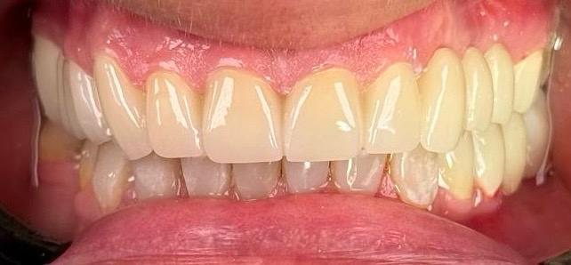 After — Natural monolithic zirconia