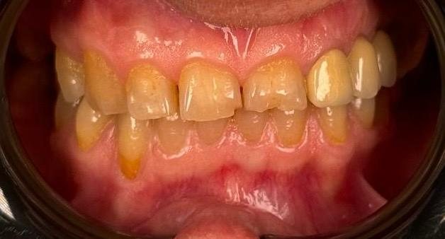 Before — Natural monolithic zirconia